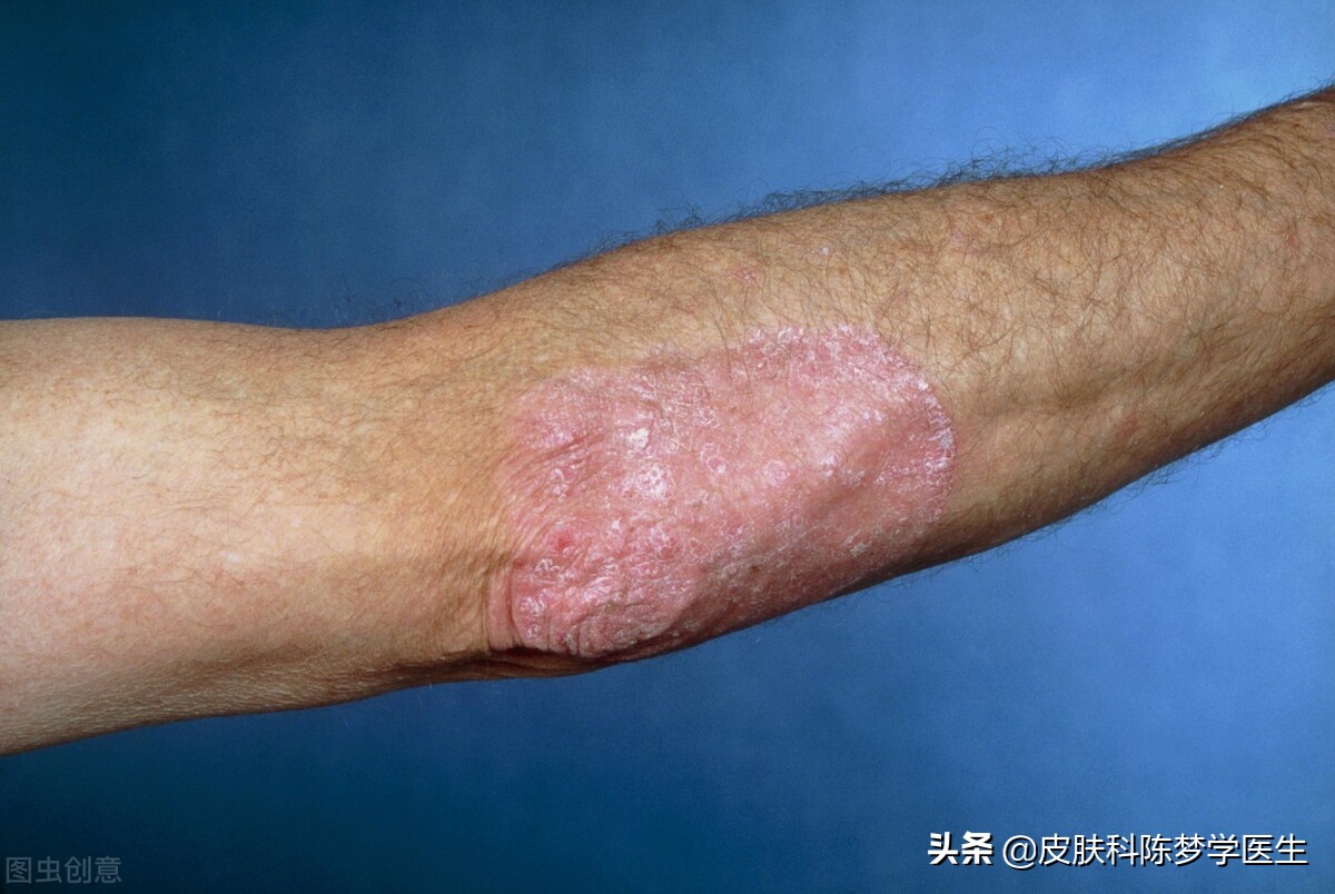 皮肤上长红斑、脱屑，是不是得了牛皮癣？