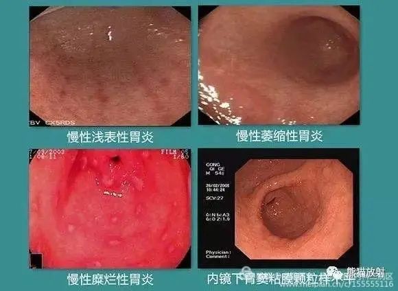 预防胃炎健康宣教,西医怎么治慢性胃炎消化不良