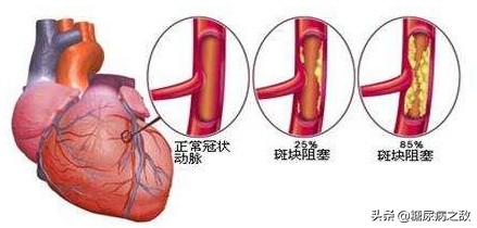 药物、支架、搭桥手术，糖尿病冠心病患者该治疗如何选择治疗方式