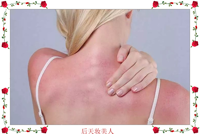 晒伤后护理知识,晒后身体晒伤急救擦什么