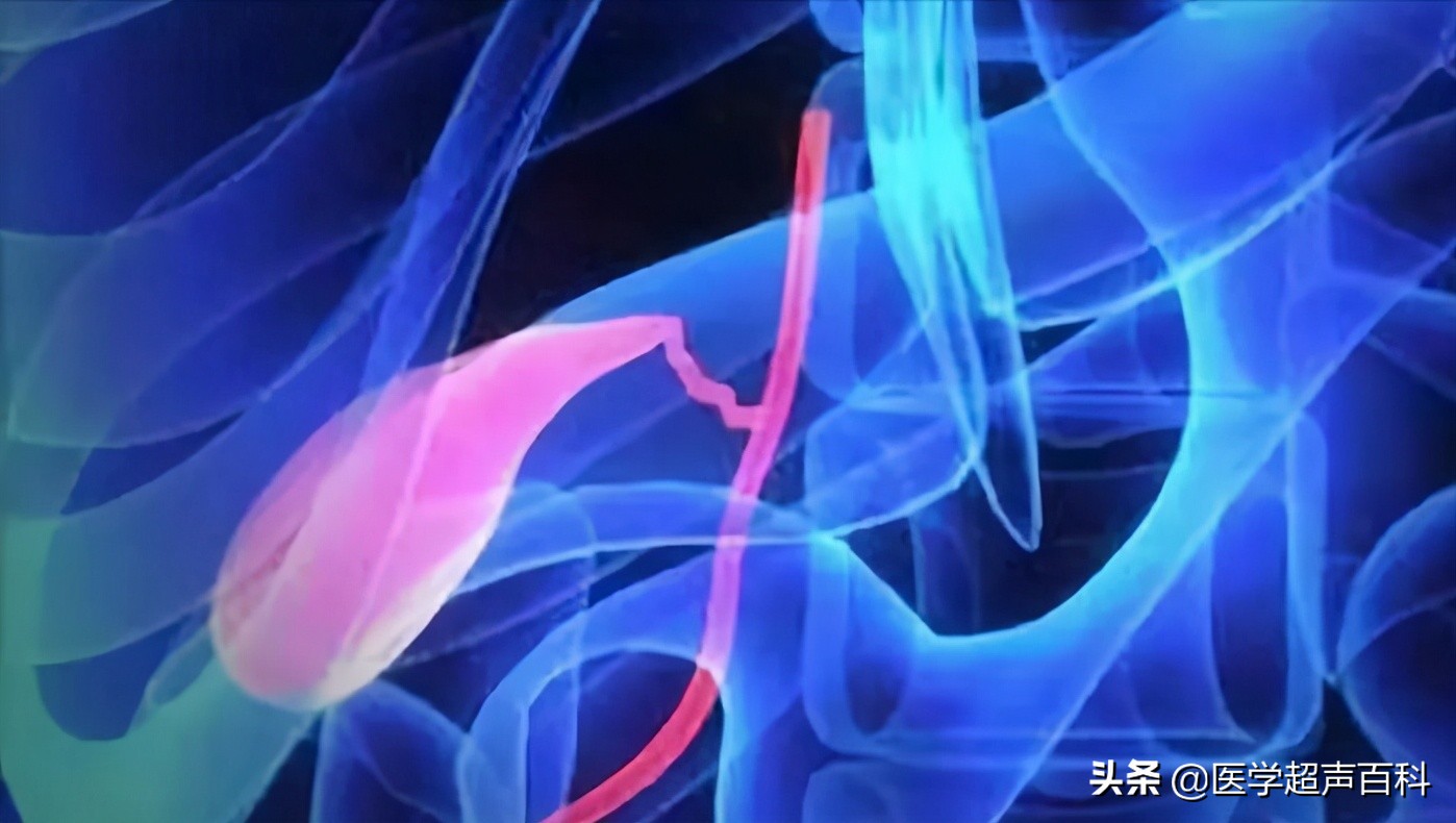 胆结石最简单的解决方法,胆结石只有一个最佳治疗方法