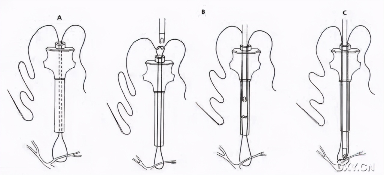 腹腔镜下切割缝合器使用视频,腹腔镜下缝合教程