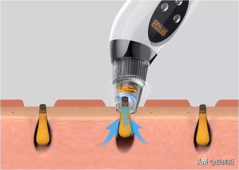 祛除黑头的有效方法及错误方法,黑头的成因以及祛黑头的方法