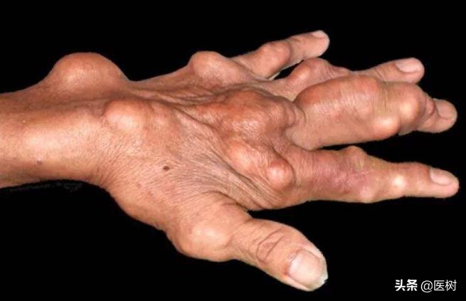 痛风肾衰竭预后怎么样,痛风并肾衰怎样治疗