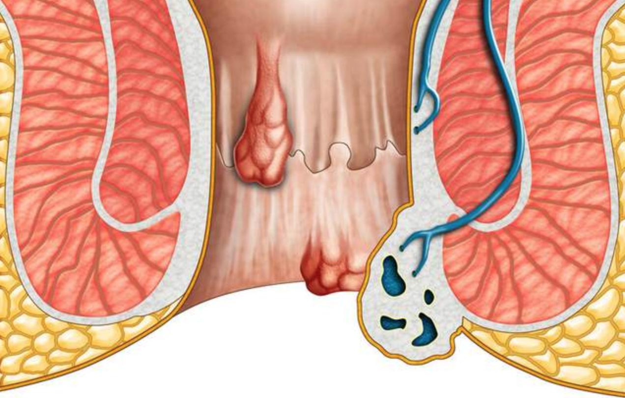 痔疮脱垂不等于直肠脱垂!两者区别大,千万不要混淆了