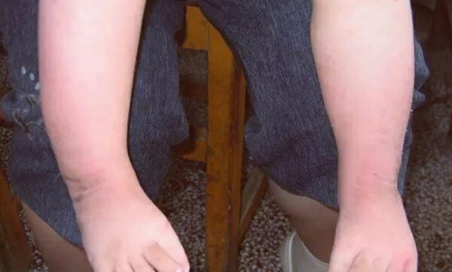 小孩出生脚内翻,宝宝出生脚有一个足内翻怎么办