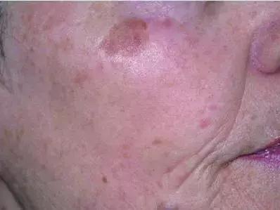 只需3步淡化斑点,简单4招快速淡化色斑