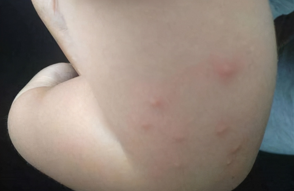 博德妈妈亲亲：小孩身上起红疙瘩很痒怎么办？