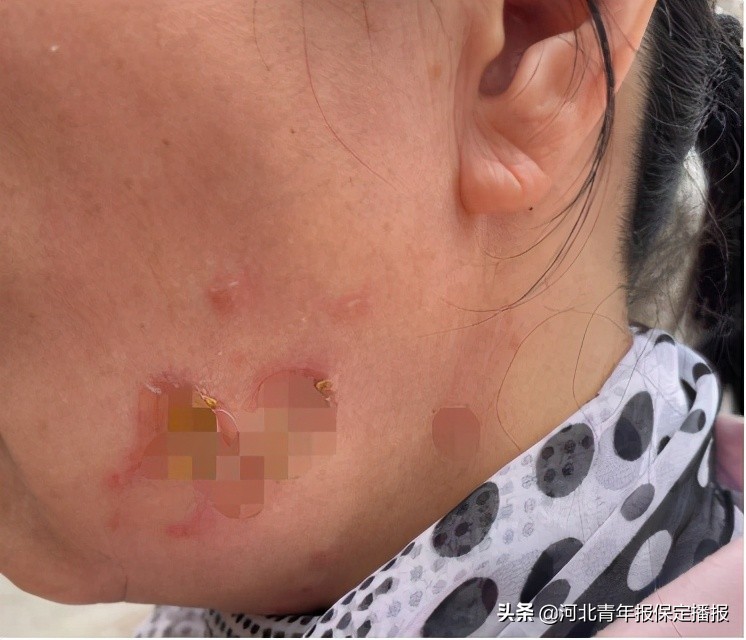 女子花2万元做热玛吉,保定热玛吉事件