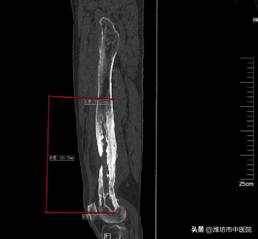 慢性骨髓炎是不是终身无法治愈,慢性骨髓炎持续疼痛吗