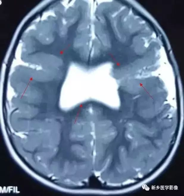 脑室影像学表现,脑室占位影像