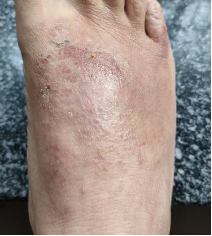 双脚心对称性皮炎是何病,双小腿对称性神经性皮炎怎么治疗