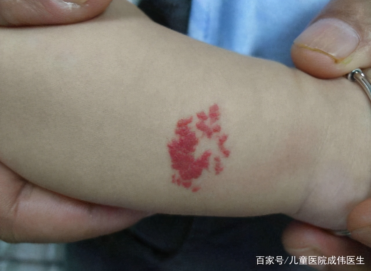 如何辨别宝宝是红胎记还是血管瘤,宝宝身上青一块紫一块图片