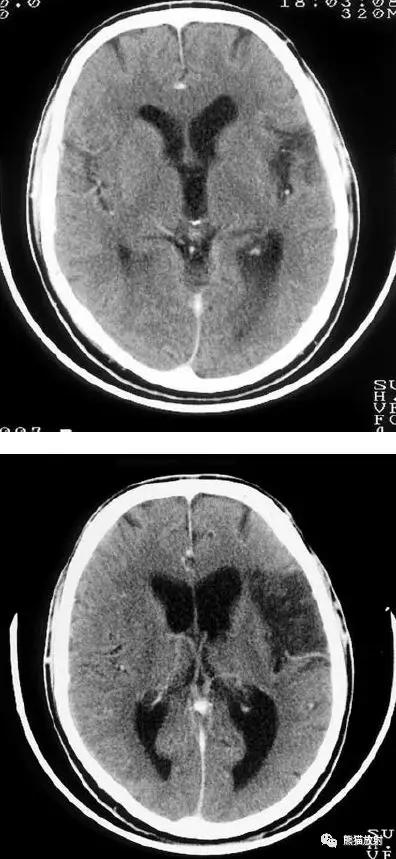 各部位脑梗死ct影像讲解,脑梗死ct影像最简单的是什么表现