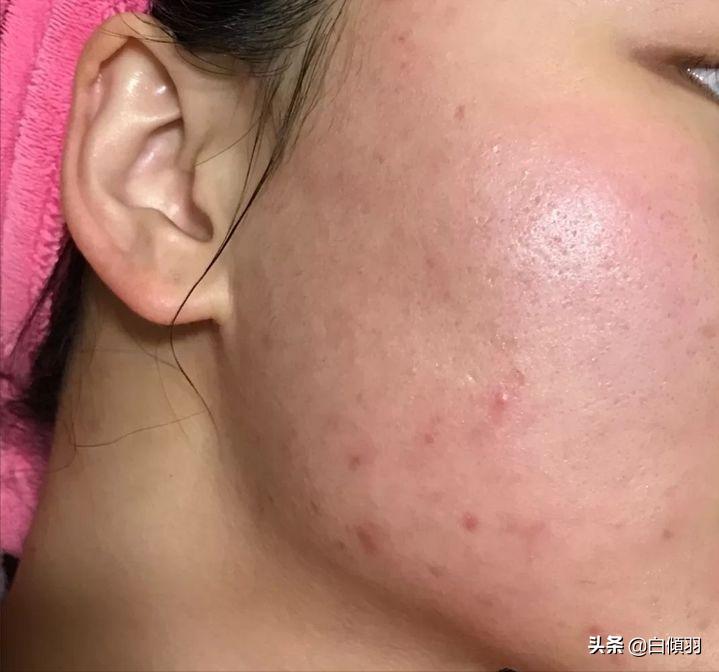 红肿硬块痘痘没有脓怎么快速消退,红肿痘痘不疼了但是还是有包