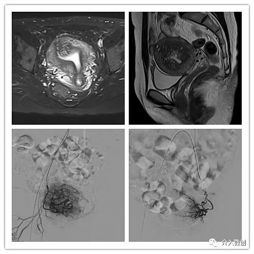 「不死的癌症」之克星——子宫腺肌症介入栓塞治疗