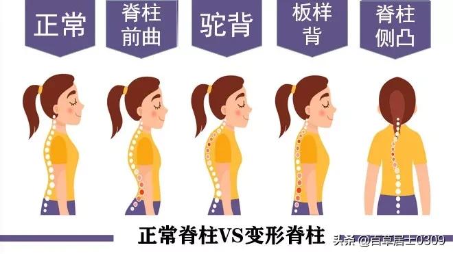 长期驼背导致脊椎凸起怎么办,年纪轻轻就驼背怎么矫正