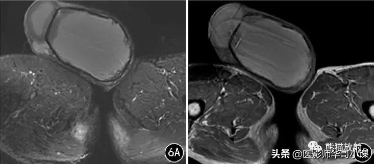 [精品课件]畸胎瘤及精原细胞瘤（*丸睾**肿瘤及肿瘤样变CT及MR表现）