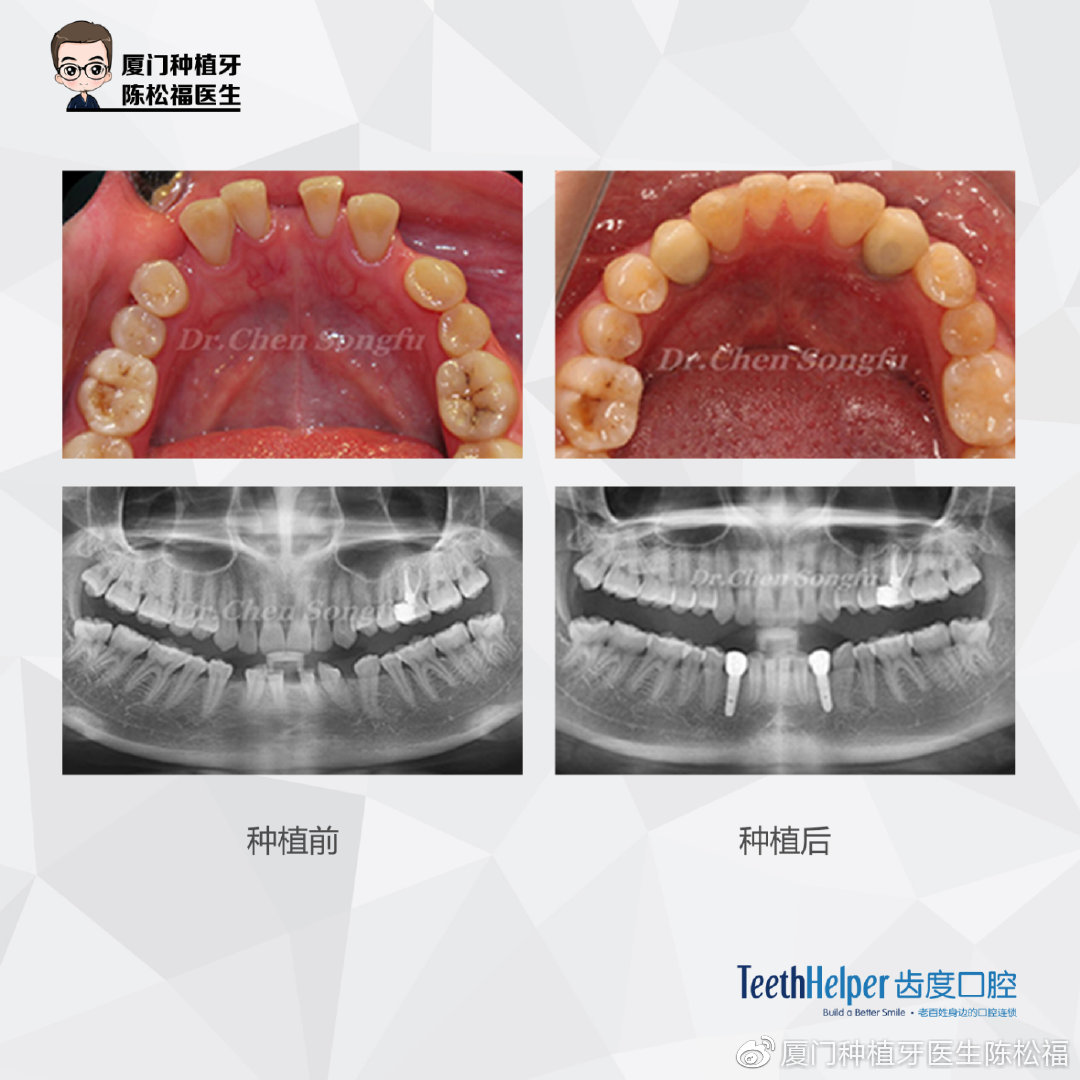 厦门种植牙陈松福,口腔正畸案例分享