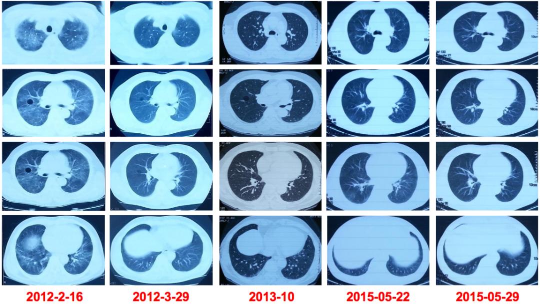 养鸽子造成皮肤真菌感染,养鸽子会得肺炎吗