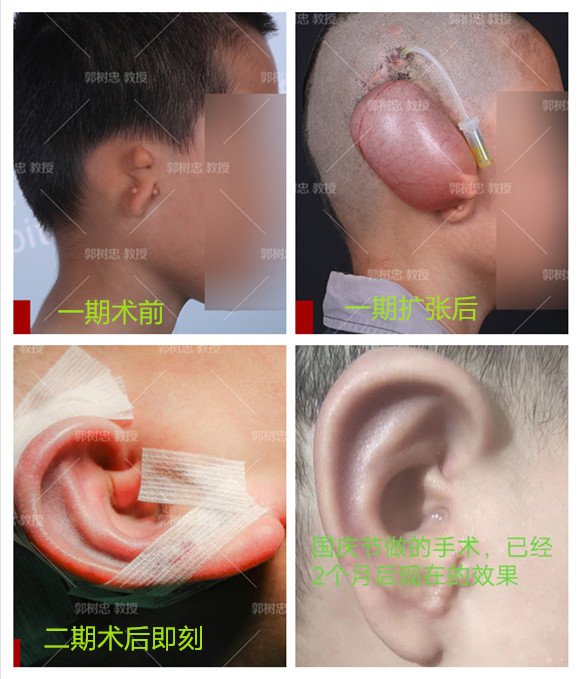 小耳病,小耳病是什么