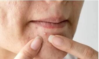 柳芙祛痘印最有效的方法,柳芙祛痘精华怎么样