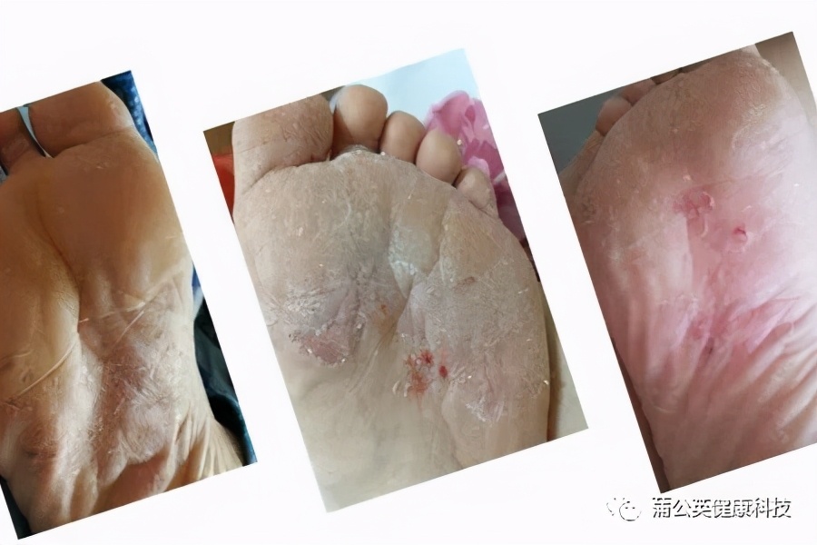 手脚癣痒烂怎么治疗,手脚癣用什么药水泡才能治好