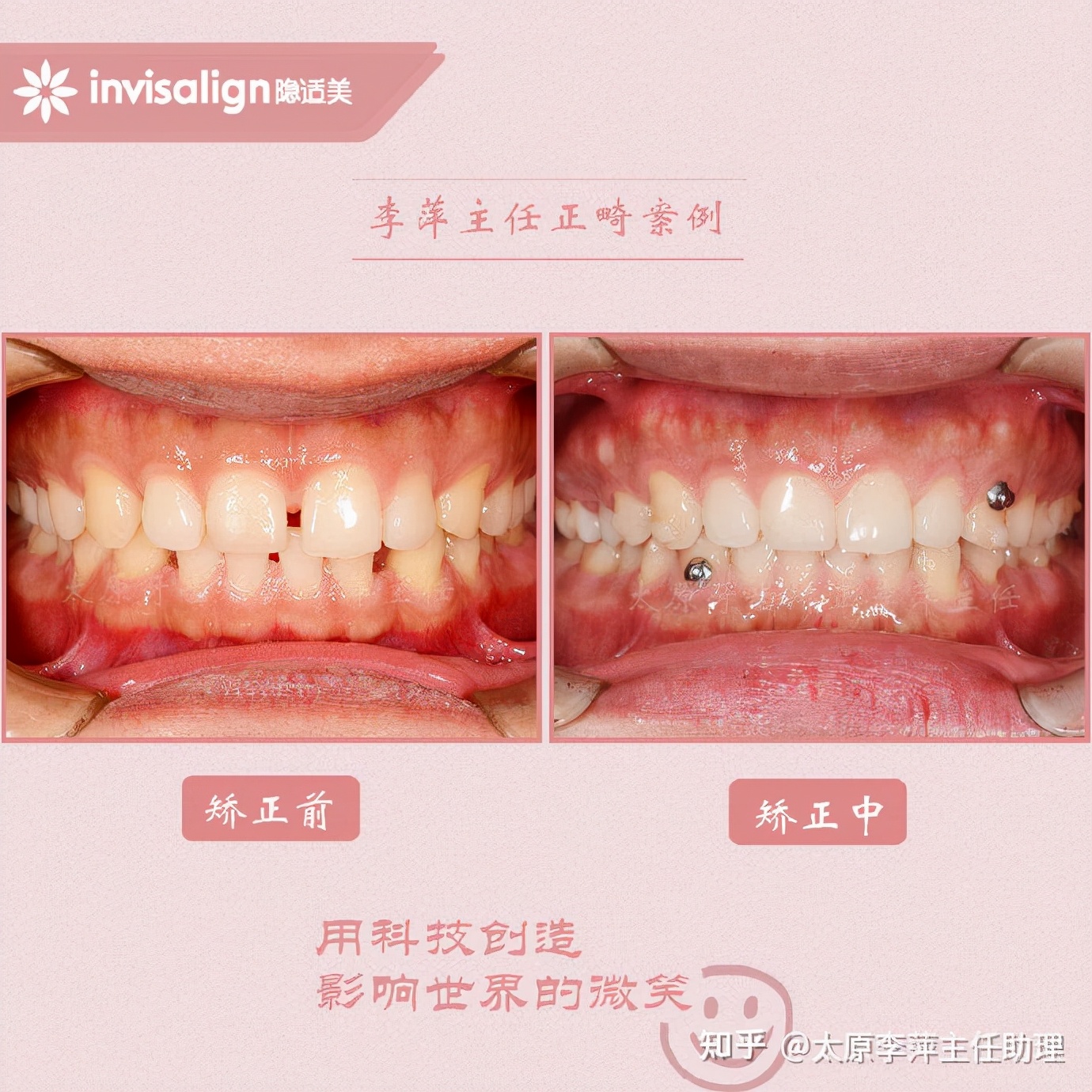 重度拥挤矫正牙齿适合隐形牙套吗,广州成人牙齿矫正推荐隐形牙套