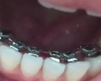 正畸初学者怎么能快速上手,深覆合正畸戴牙套先怎么弄