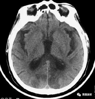 各部位脑梗死ct影像讲解,脑梗死ct影像最简单的是什么表现