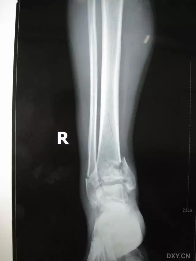 特殊骨折类型,特殊骨折体征