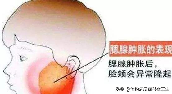 痄腮是怎么回事如何治疗,痄腮怎么治疗最快