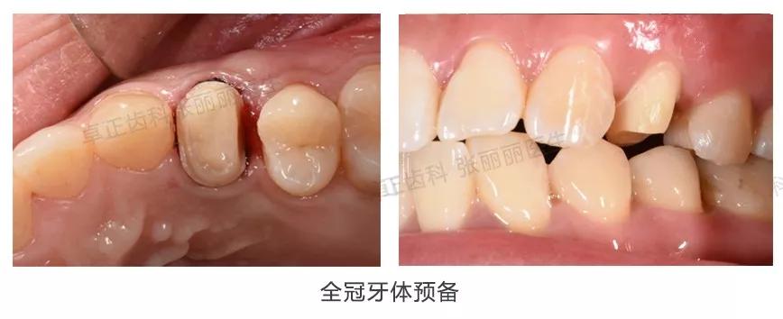 牙齿楔状缺损修复图片,牙齿楔状缺损修复大概多少钱