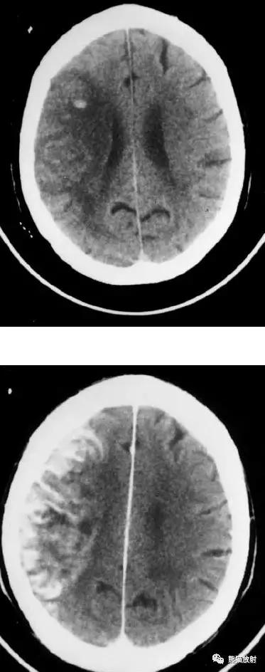 各部位脑梗死ct影像讲解,脑梗死ct影像最简单的是什么表现