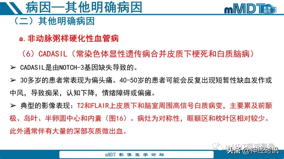 急性缺血性脑卒中ppt素材图片,青年缺血性脑卒中ppt