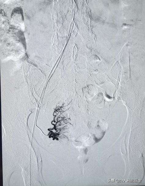 子宫出血、尿频和尿痛、月经增多，警惕得了子宫肌瘤的5大症状
