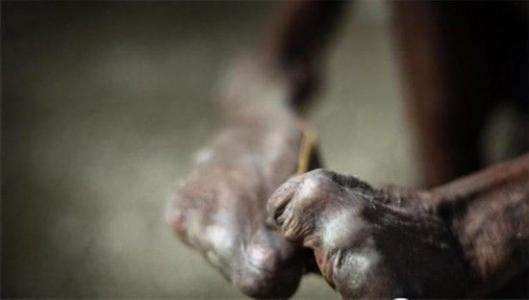 「怀融日历」1月的最后一个周日，“国际麻风节”，关爱麻风病人