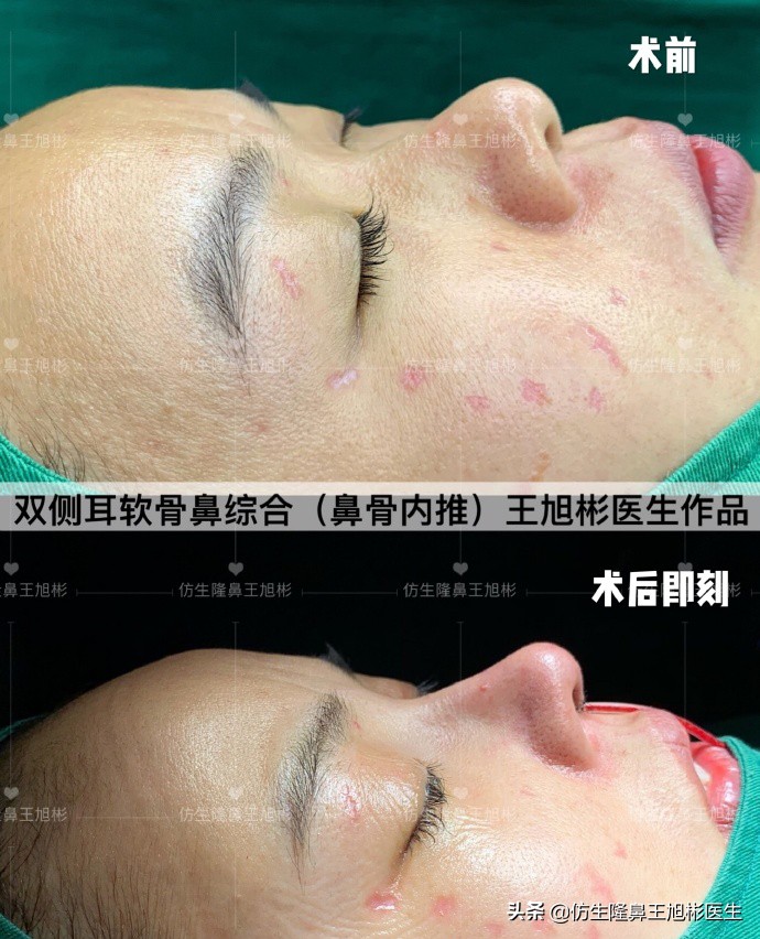 鼻中隔重塑鼻头,鼻中隔重建整形