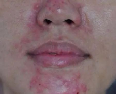 前胸后背长痘痘是毛囊炎吗,前胸后背很容易长痘痘中医治疗