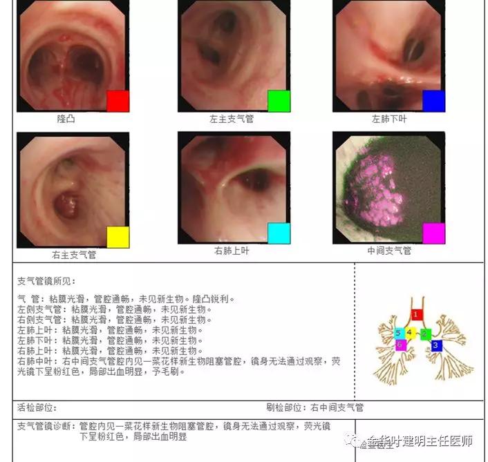 省级医院也漏诊?还好没耽误病情!我们予以行右中下叶袖式切除术