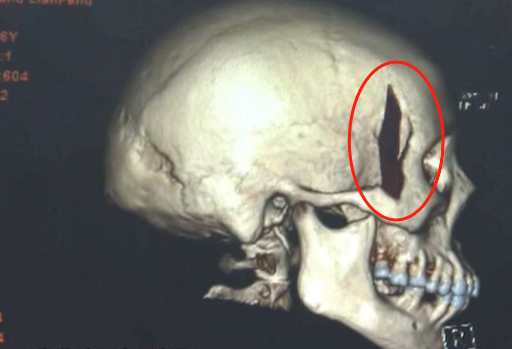 女子脸上长痘流脓,女的脸上流脓