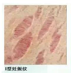 妊娠纹怎么消除才最快最有效,如何快速消除妊娠纹的有效方法