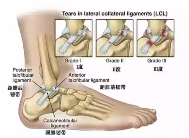 很多人崴了脚不知道该怎么办,那些崴脚后的人现在怎么样了
