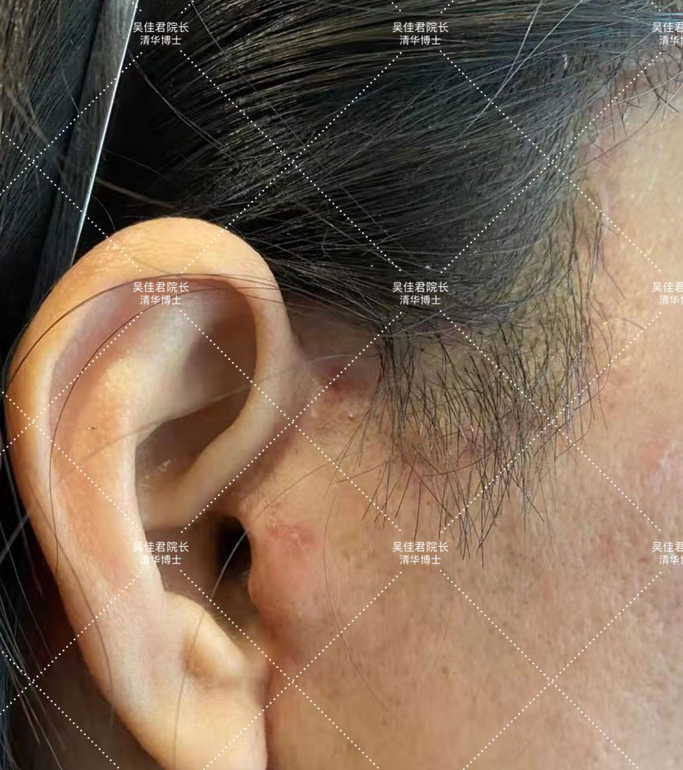 拉皮手术后三个月的恢复过程,拉皮术后10天白天可以不戴头套吗