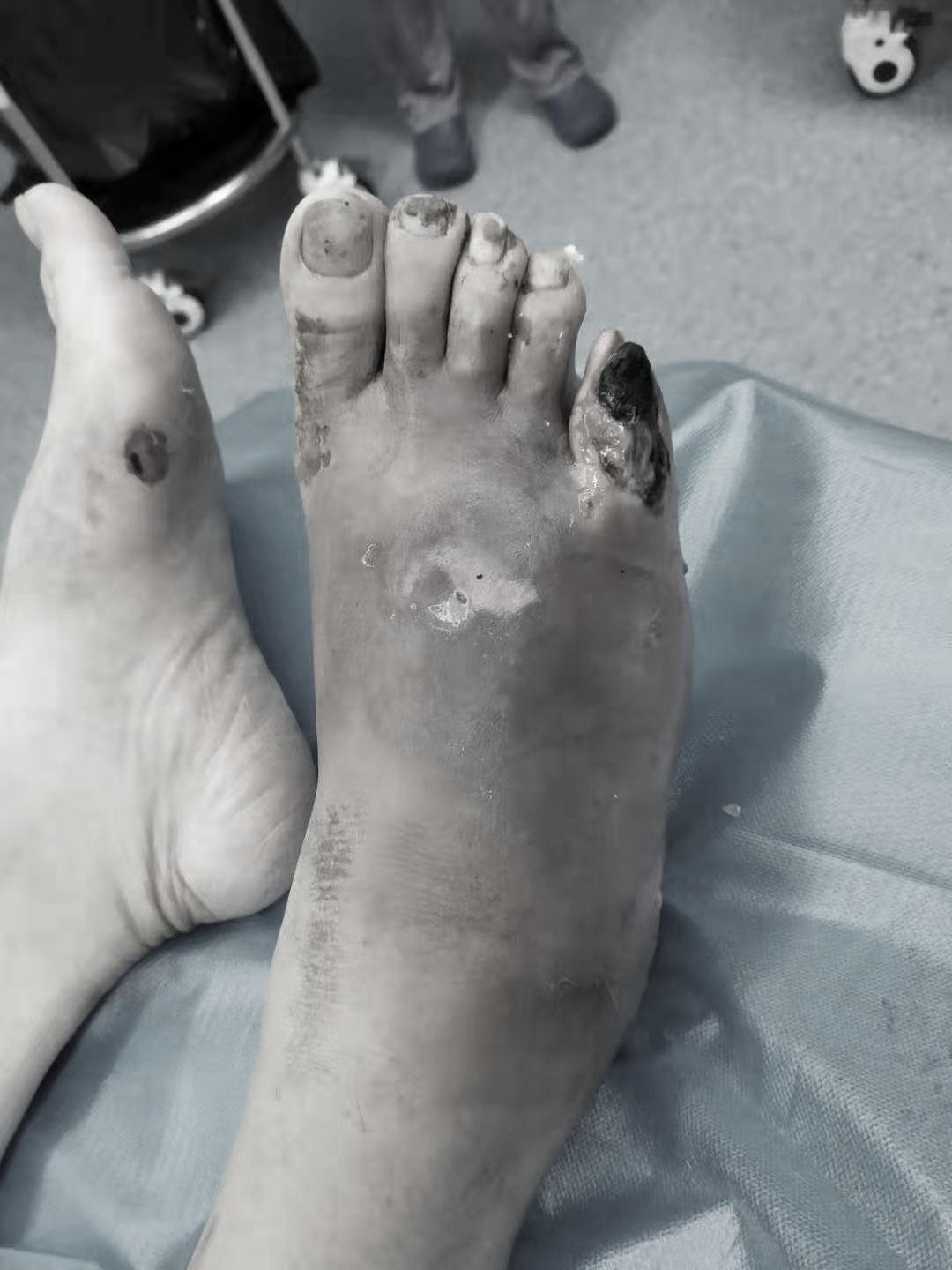 中西医结合治疗糖尿病,糖尿病足中西医结合指南