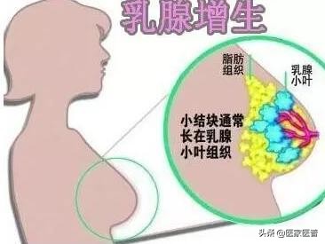 关于女性乳腺增生的有关小知识
