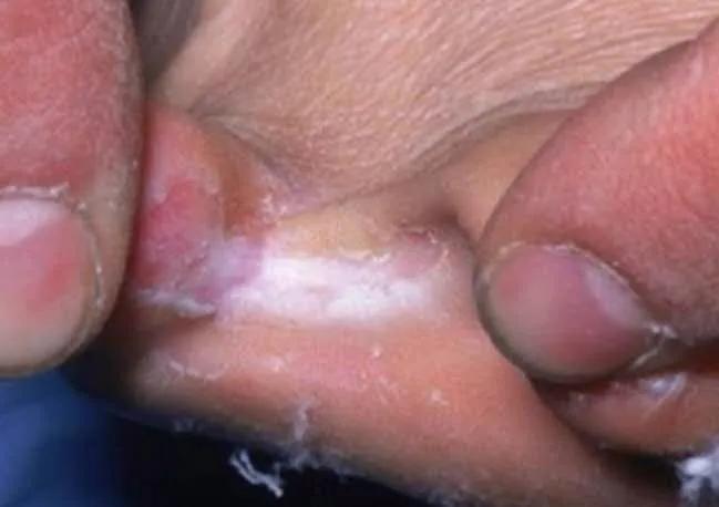 轻知识计划5招教你根治脚气,有没有治愈脚气的好方法