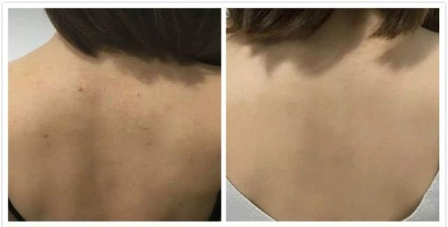 祛痘痘后背好物推荐,祛除背部痘痘好物推荐