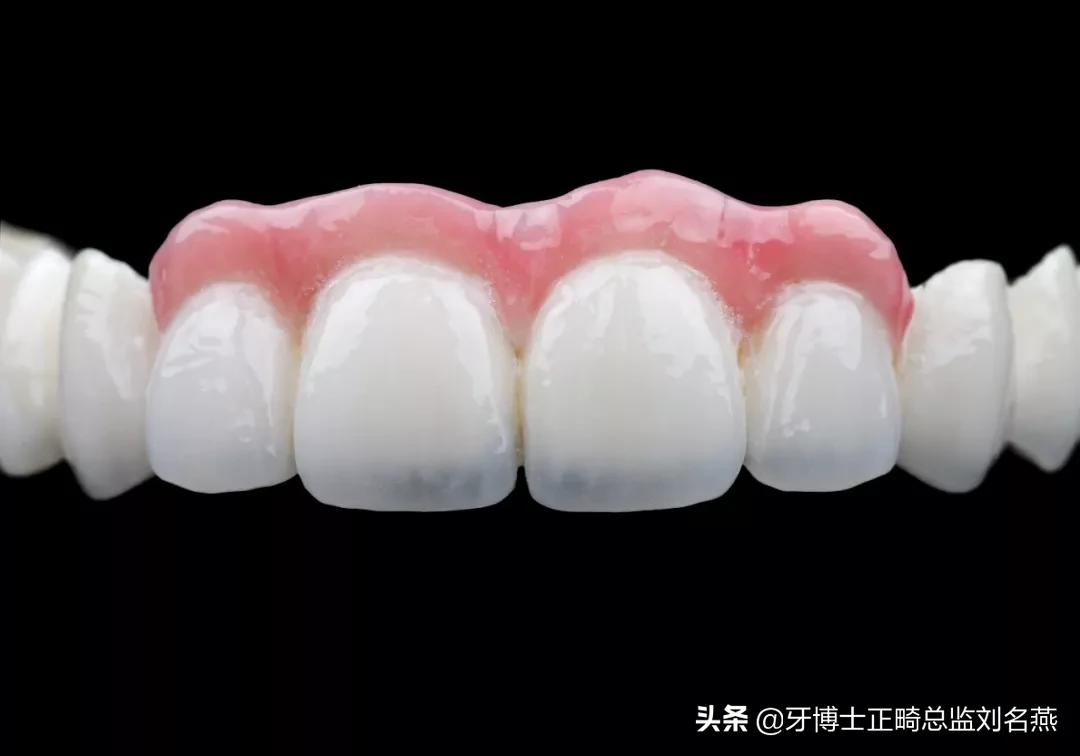 缺牙做修补和烤瓷哪个好,缺牙修复有几种方法