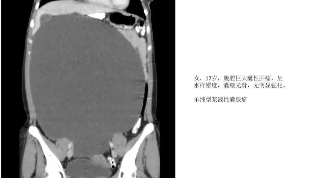 卵巢原发肿瘤的分析思路